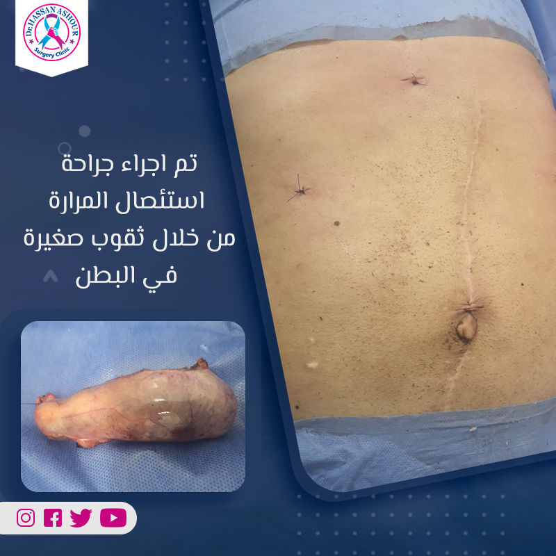 كل ما يجب معرفته عن استئصال المرارة بالمنظار ونسبة نجاحها 4 استئصال المرارة بالمنظار مع الدكتور حسن عاشور