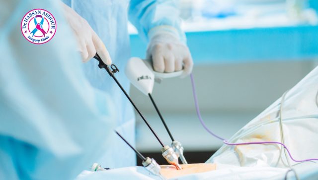 استئصال المرارة