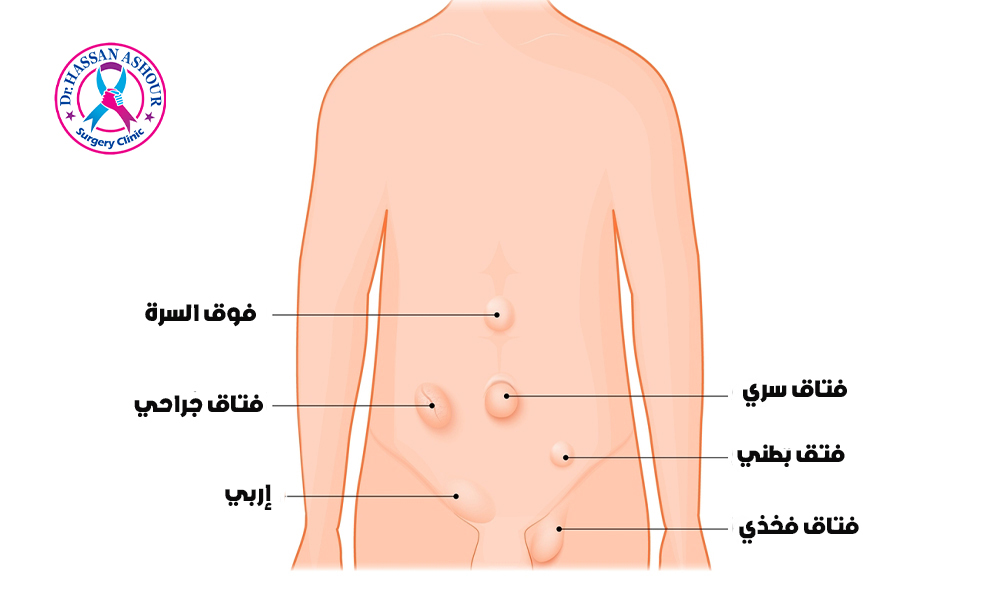 اماكن الفتاق